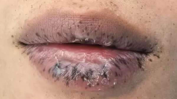 嘴唇突然出现很多纹路怎么回事(嘴唇出现这种变化，竟是体内有癌！男子五雷轰顶，母亲因此病去世)