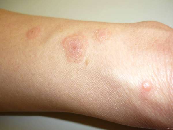 人不会无故患糖尿病的原因(人不会无故患皮炎！医生提醒背后4大原因，早了解早预防)