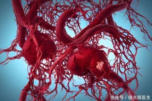 动脉疾病早期的3个信号(动脉硬化的早期信号，3个症状别忽视，尽早治疗效果更好)